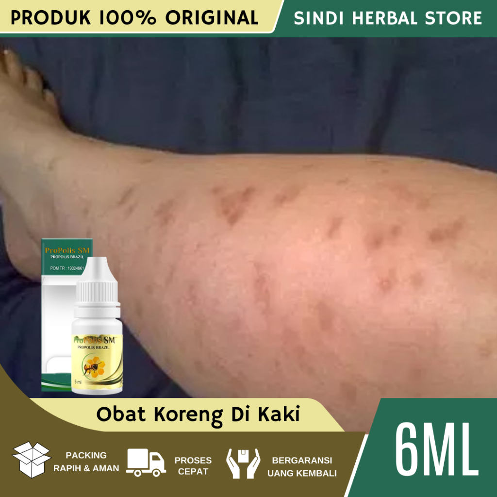 Obat Koreng Di Kaki - Obat Bekas Luka Koreng - Obat Koreng - Penghilang Bekas Koreng - Obat Koreng B