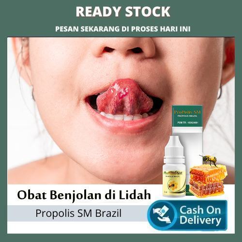 Obat Benjolan di Lidah - Obat Penghilang Benjaolan Lidah Alami, Obat Penyakit Lidah, Obat Lidah Anak