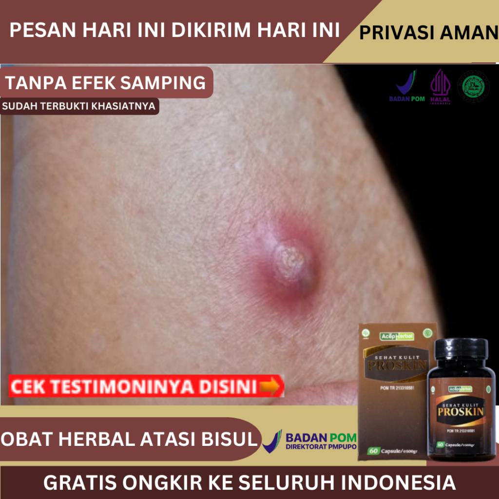 Obat Bisul, Obat Penghilang Bisul, Bisul Di Ketiak, Bisul Di Pantat, Bisul Di Tangan, Bisul Di Kemal