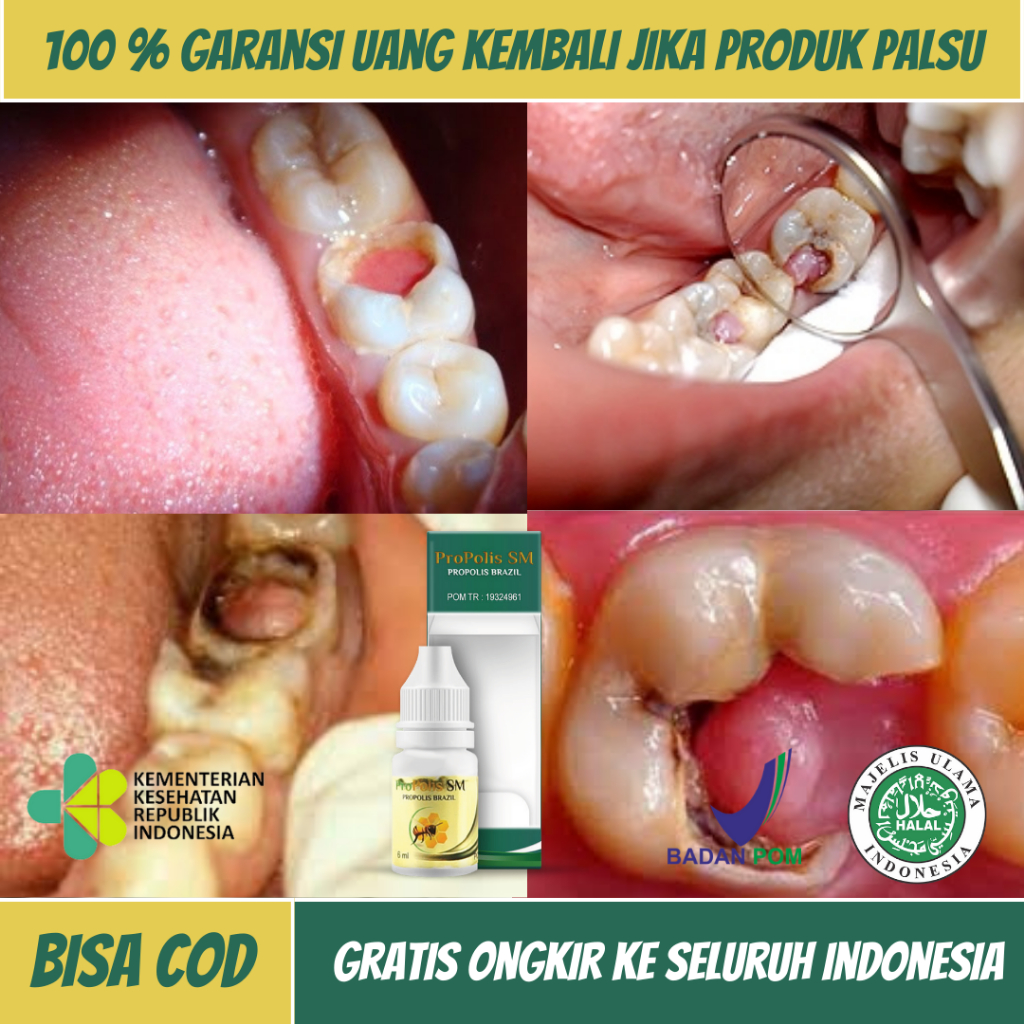Obat Polip Gigi, Obat Polip Pulpa, Obat Penghilang Daging Di Lubang Gigi, Obat Daging Jadi, Obat Gus