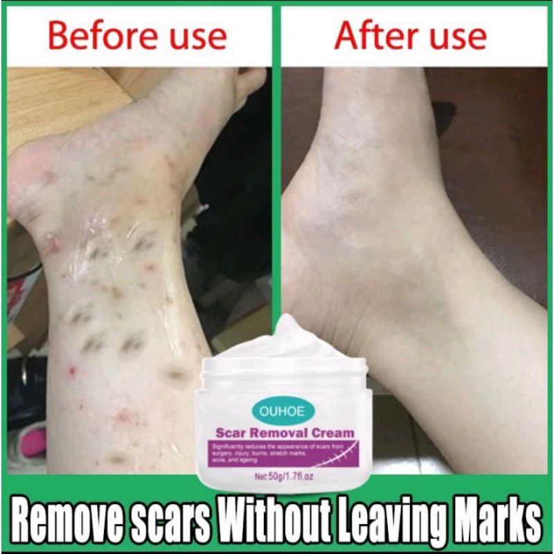 Scar Remover Cream Penghilang Bekas Luka Koreng Advanced Scar Gel Dermatik Obat Bekas Luka