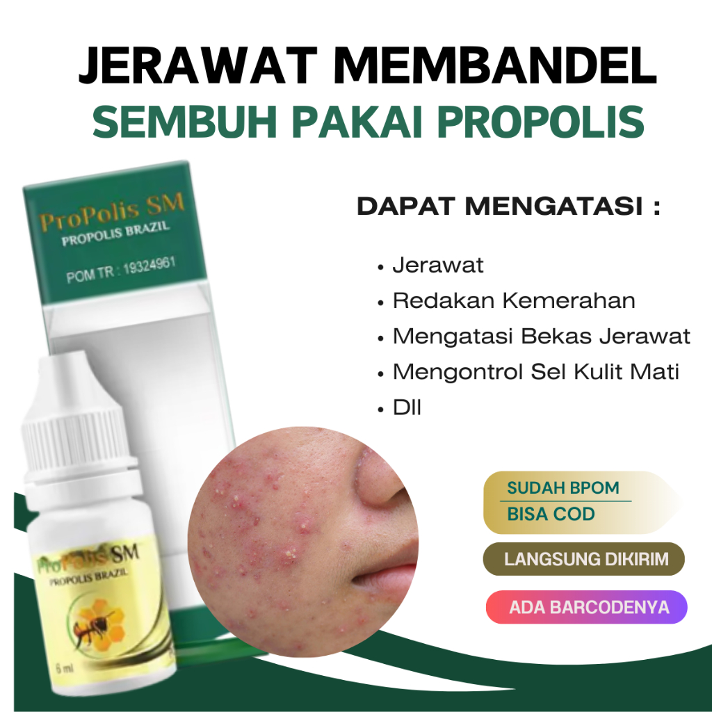 Obat Totol Jerawat - Obat Jerawat Dan Penghilang Bekas Jerawat Propolis SM