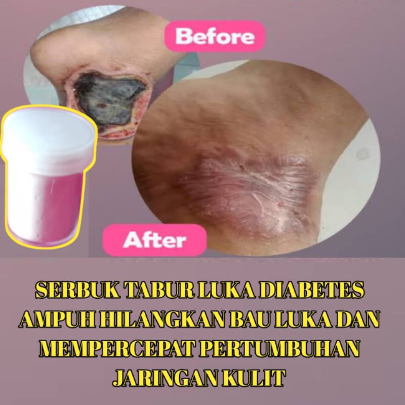 SERBUK TABUR PENGHILANG BAU LUKA DIABETES DAN MEMPERCEPAT PERTUMBUHAN