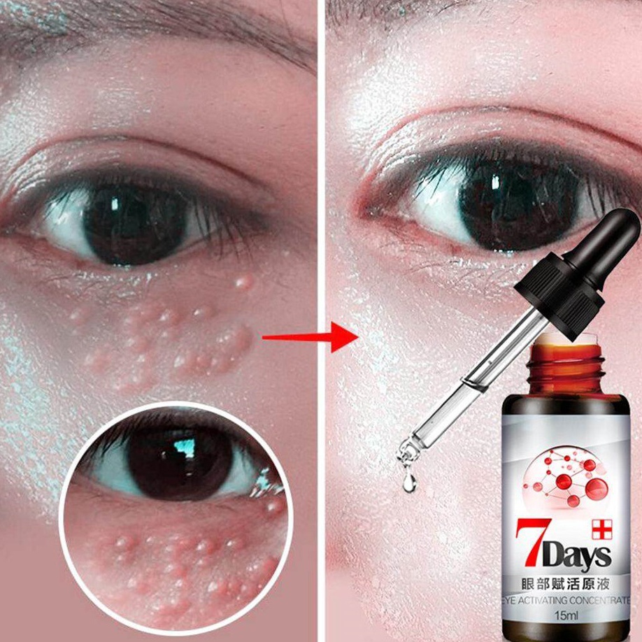1212 Obat Penghilang Milia Penghilang Bintik Bintik Putih di Bawah Mata  Obat Milia Obat Bintik Bawa