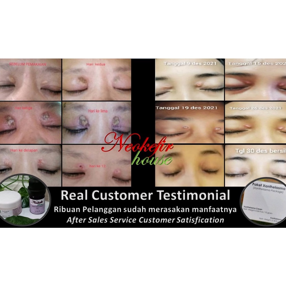 Paket Xanthelasma  obat salep xanthelasma 1gr dan minyak xanthelasma 5 ml  hilangkan lemak mata kare