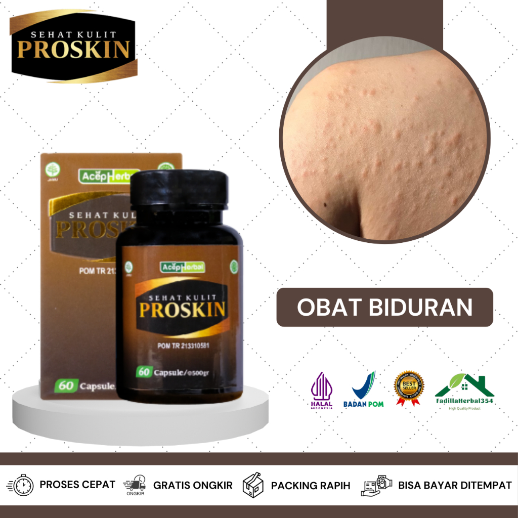 Obat Biduran, Obat Biduran Menahun, Obat Kaligata, Obat Kulit Bintik Bintik, Obat Kulit Bintik Merah