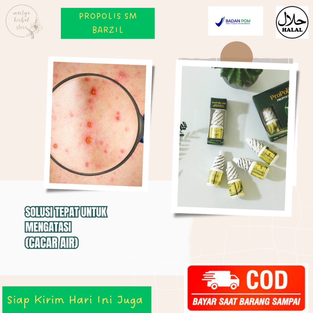 Obat Oles Cacar Air Obat Cacar Monyet Obat Cacar Api Obat Cacar Kulit Bintik Gatal Salep Cacar Air A