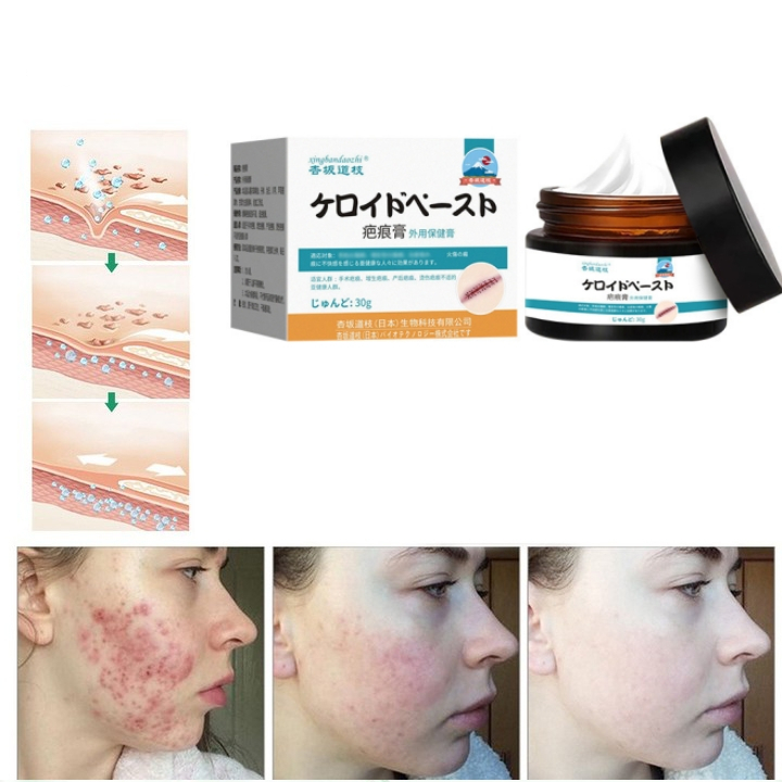 Penghilang bekas luka hitam koreng Penghilang bekas luka di kaki Penghilang Bekas cacar Bekas