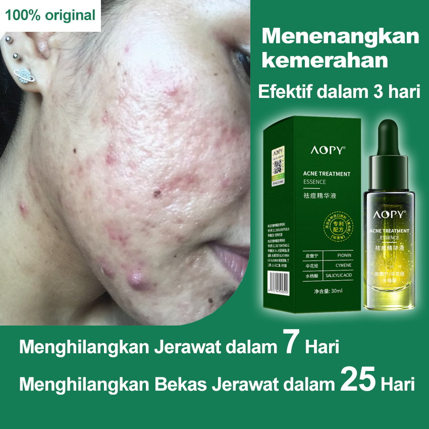 serum jerawat dan bekas jerawat paling ampuh Acne Treatment Serum 30ml Menghilangkan Jerawat dan Bek