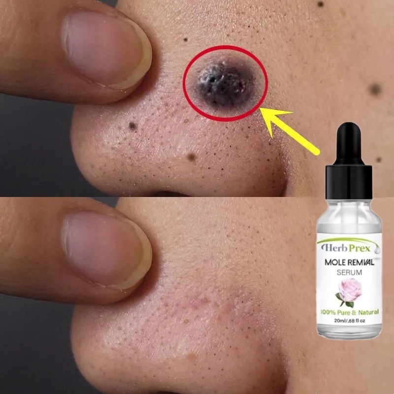 penghilang tahilalat di wajah Obat Penghilang Kutil Lotion obat kutil di leher Penghilang papiloma p