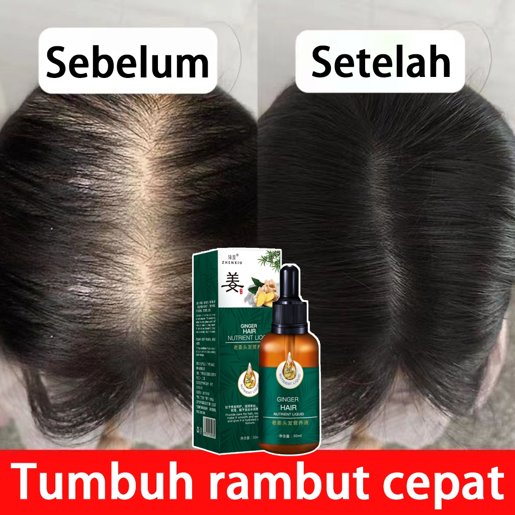 【Beli 3 gratis 2】Penumbuh Rambut Ginger Germinal Oil Penumbuh rambut cepat Mencegah Kebotakan botak 