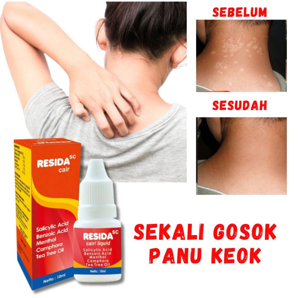 Obat Panu Paling Ampuh 100% Resida Salep Kurap Kadas Kudis Gatal Original Kulit Di Wajah