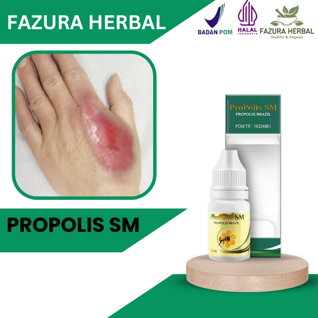 Propolis SM - Obat Penghilang Bekas Luka Bakar, Obat Luka Bakar Knalpot, Obat Luka Melepuh
