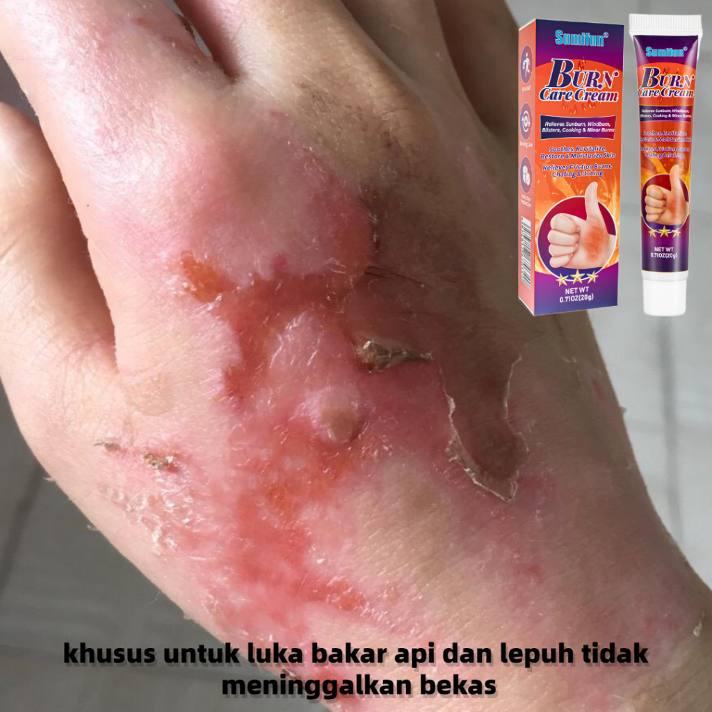 salep luka bakar salep luka bakar cream Krim Luka Bakar blister penghilang bekas luka  salep penghil