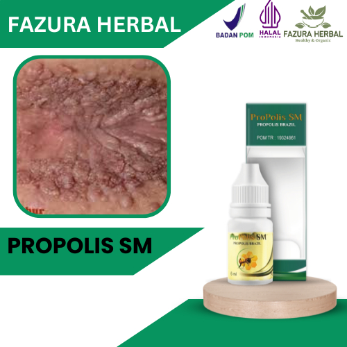 Propolis SM - Obat Untuk Atasi Kutil Anus, Obat Kutil Dubur, Obat Benjolan Di Anus, Obat Abses Anus