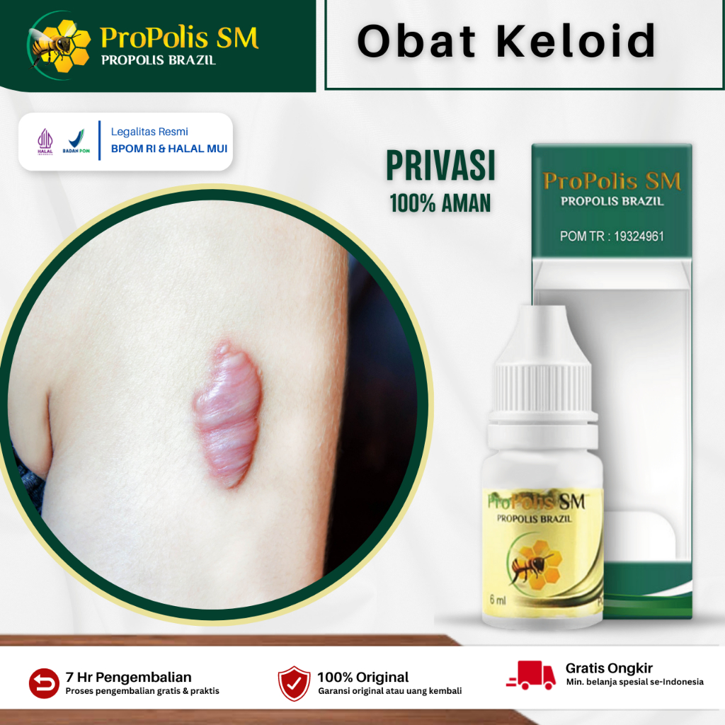 Propolis SM Obat Keloid Daging Tumbuh Keloid Bekas Operasi Kloid Injeksi Keloid Menahun Keloid Telin