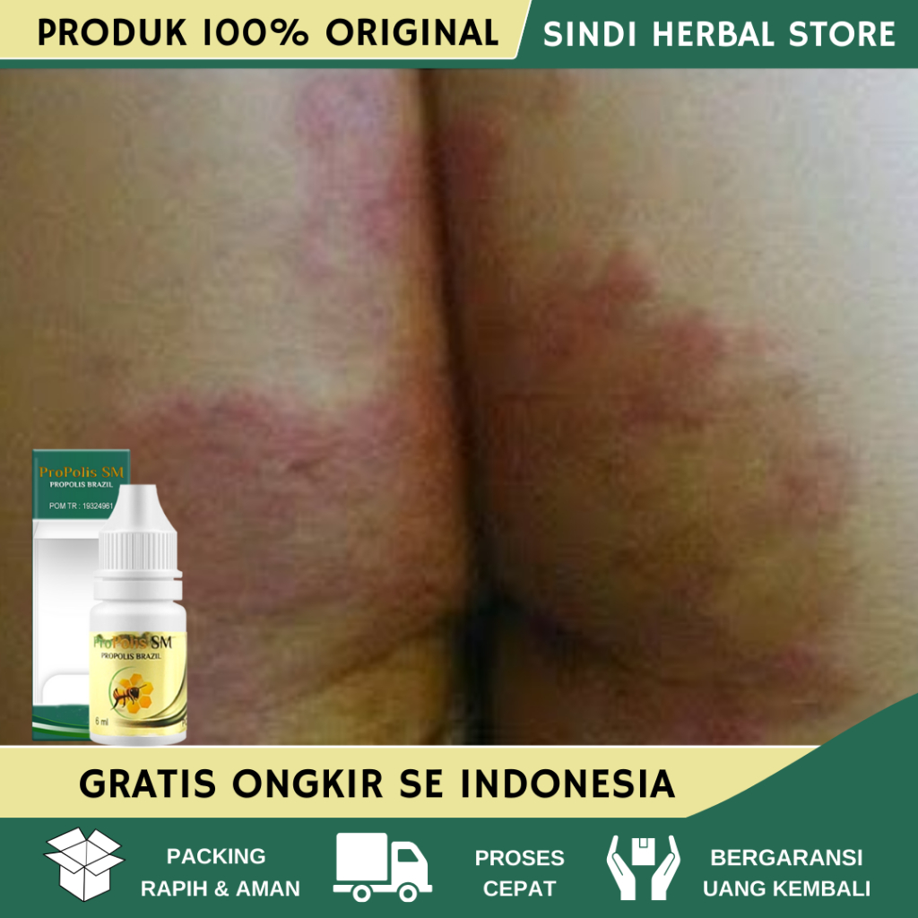 Obat Gatal Pantat, Pantat Burik, Penghilang Bekas Koreng Di Pantat, Pantat Bruntusan, Bintik Merah P