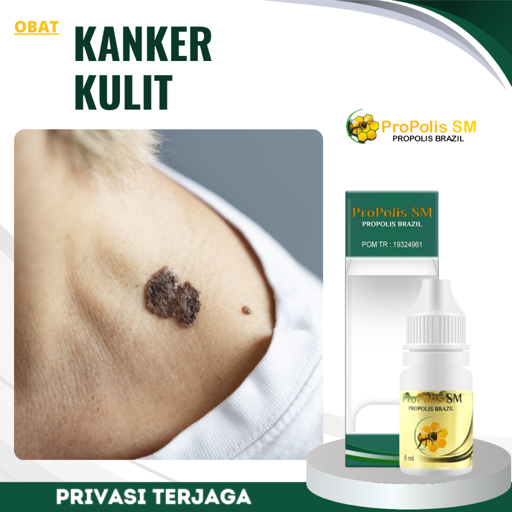 Obat Kanker Kulit, Salep Kanker Kulit Melanoma, Obat Keratosis Seboroik, Obat Penghilang Plak Kecokl