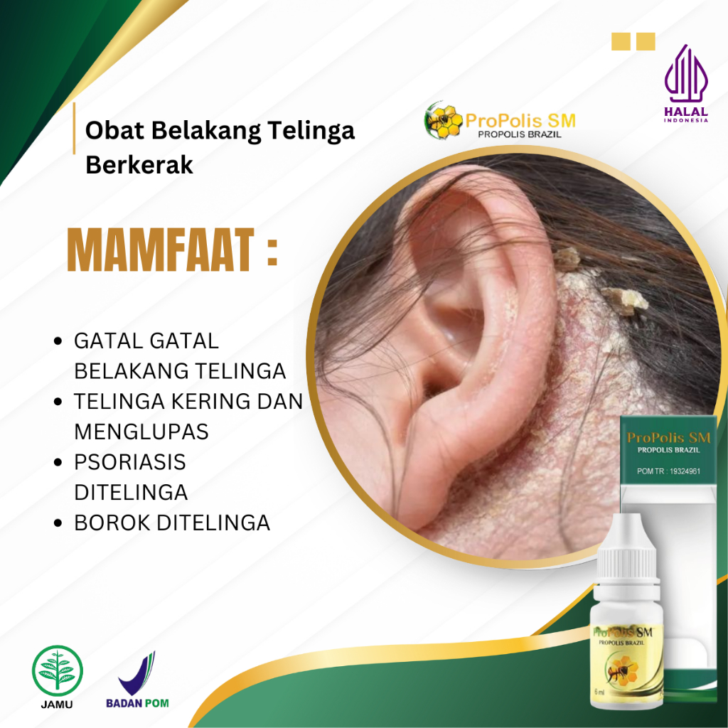 Obat Telinga Berkerak, Salep Psoriasis Kulit,  Obat Borok Di Telinga, Obat Gatal Bernanah Di Telinga