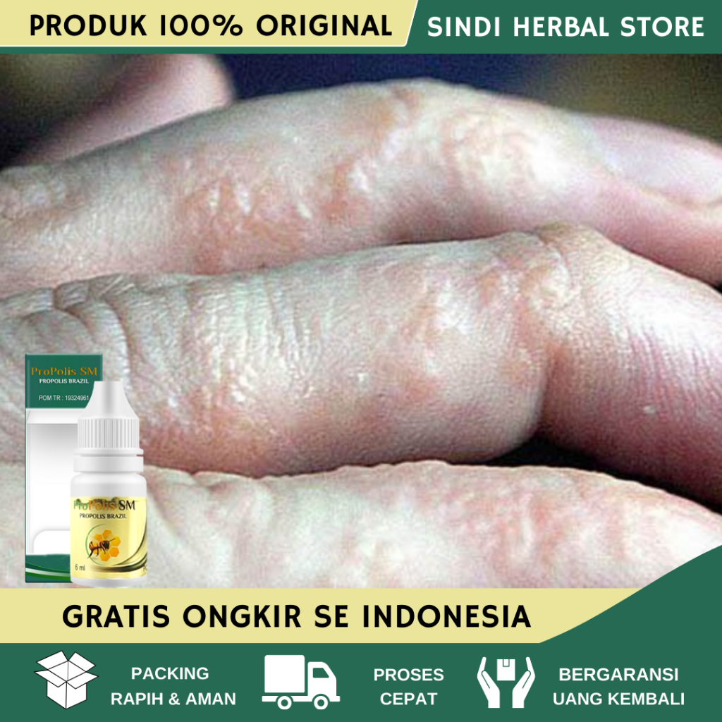 Obat Gatal Berair Di Jari Tangan, Obat Gatal Berair Menyebar, Obat Bintik Bening Berair Di Tangan, O