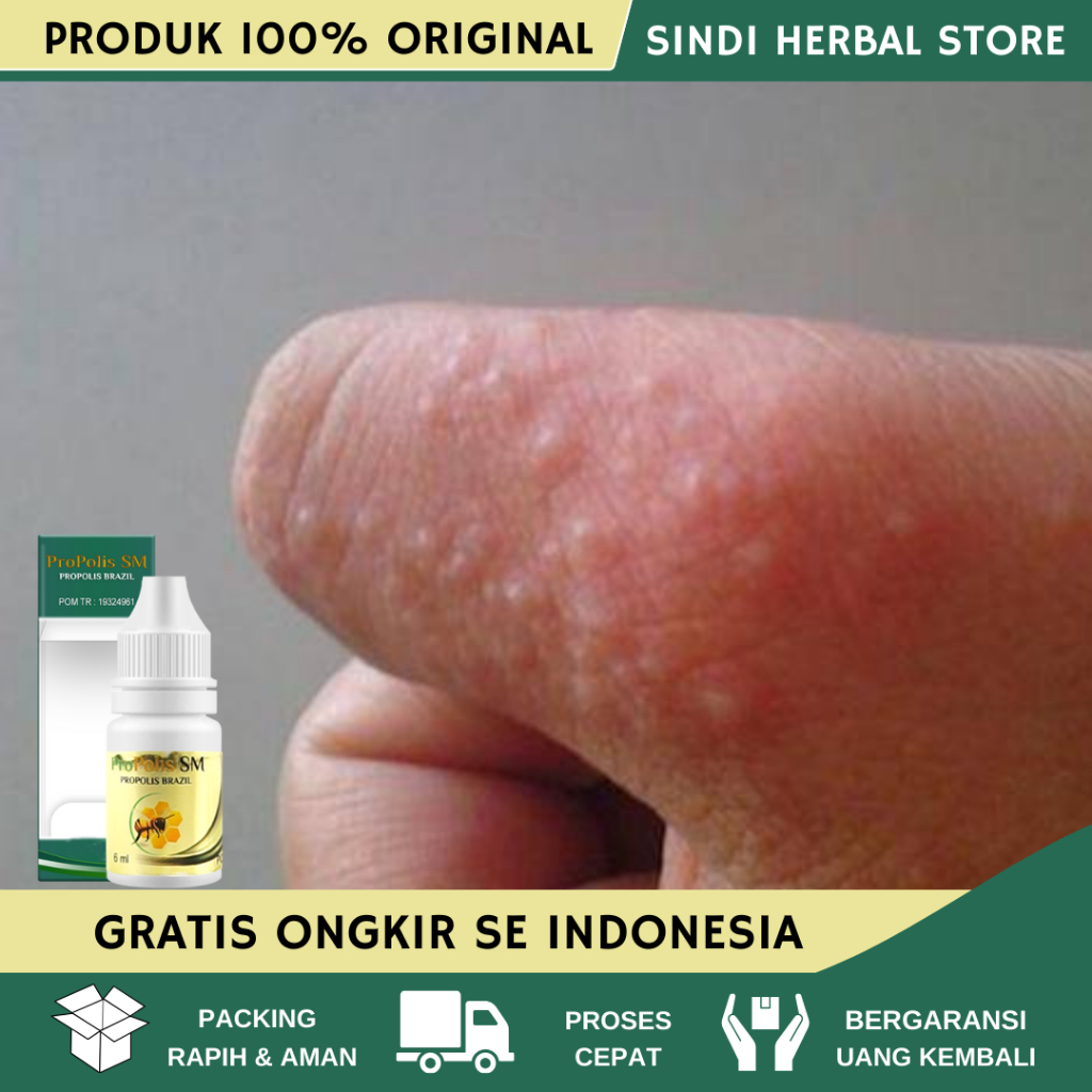 Obat Gatal Berair Di Jari Tangan dan Kaki, Obat Gatal Berair Menyebar, Obat Penghilang Bintik Bening