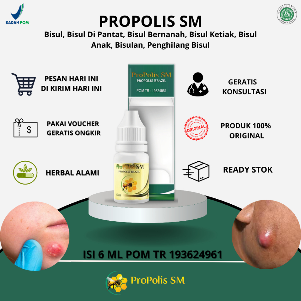 Propolis Sm - Bisul, Bisul Di Pantat, Bisul Bernanah, Bisul Ketiak, Bisul Anak, Bisulan, Penghilang 