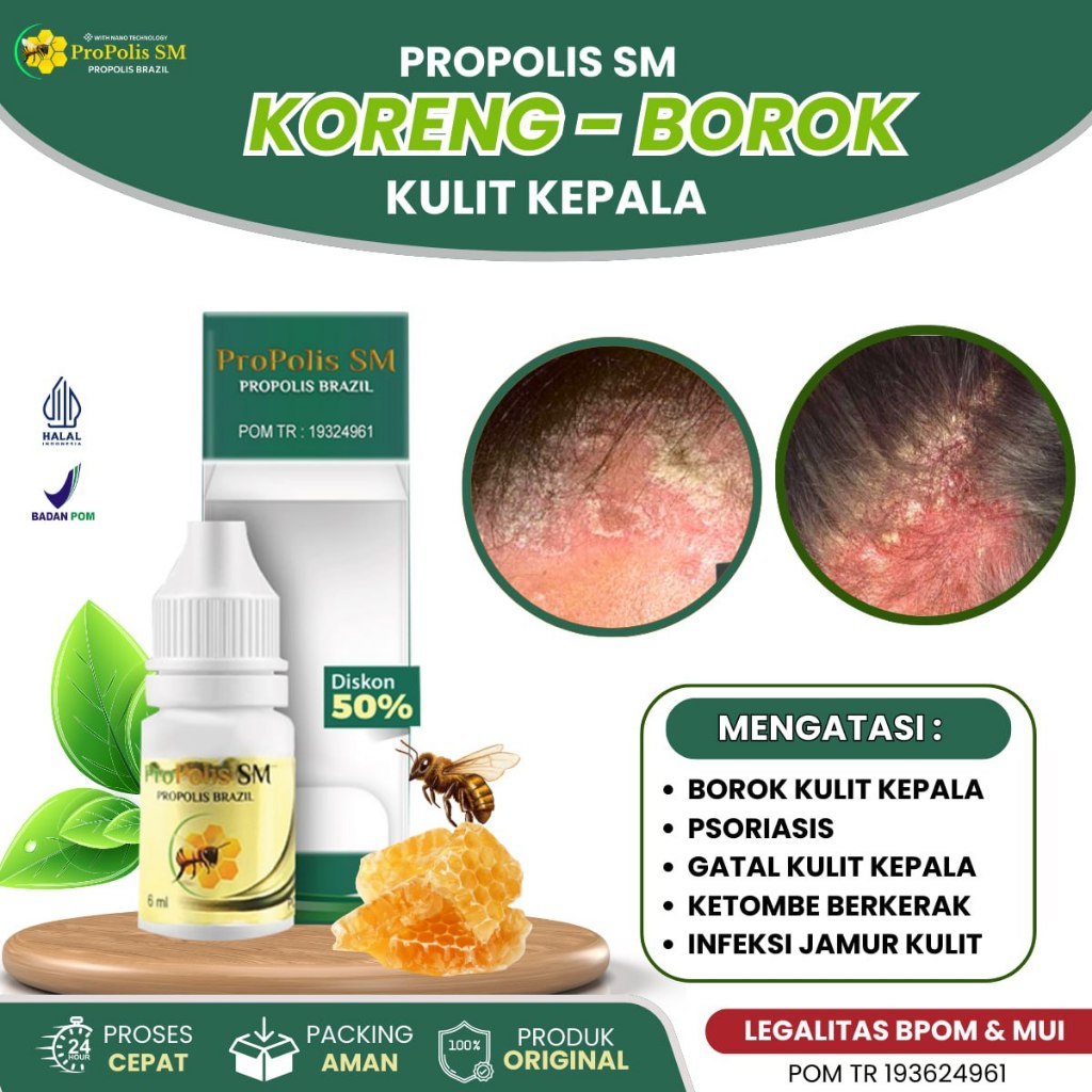 Obat Borok Korengan Ruam di Kepala, Obat Rambut Rontok, Obat Psoriasias Gatal Jamur Kulit Kepala, Ob