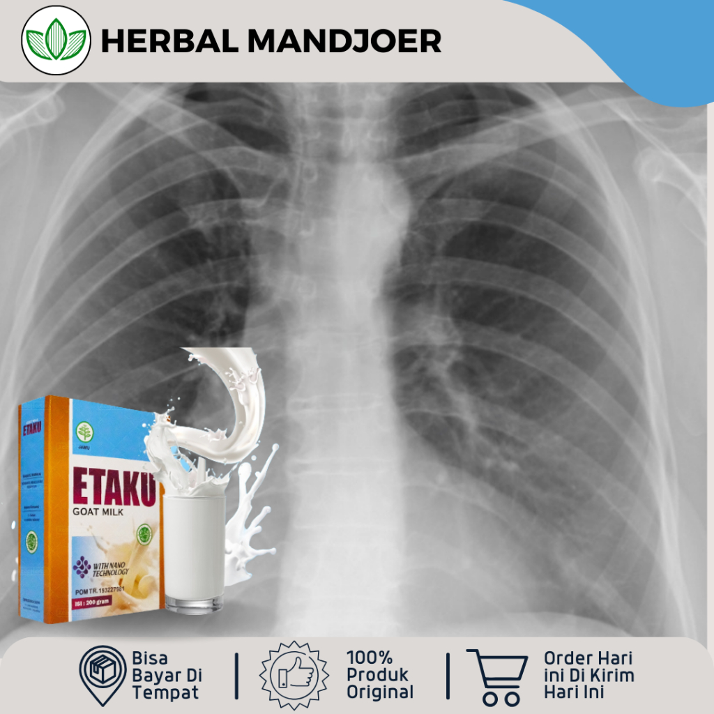 

Susu Pembersih Paru Paru Kotor Perokok, Susu Untuk Infeksi Paru Paru, Radang Paru, Susu Flek Paru Paru, Nyeri Dada, Asma, Sesak Nafas, TBC, Batuk Menahun