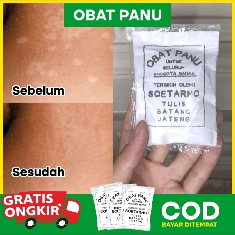 Obat Panu Ampuh Soetarno | Atasi Gatal Kulit & Kurap 100% Manjur l Obat Panu Tradisional Soetarno Bu