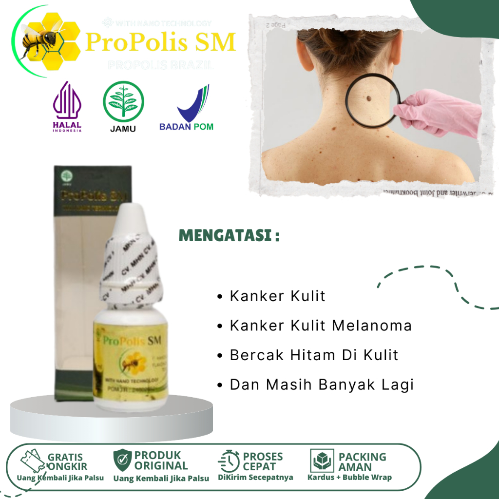 Obat Kanker Kulit, Herbal Kanker Kulit, Obat Kanker Kulit Melanoma, Obat Kanker Kulit Di Tangan Dan 