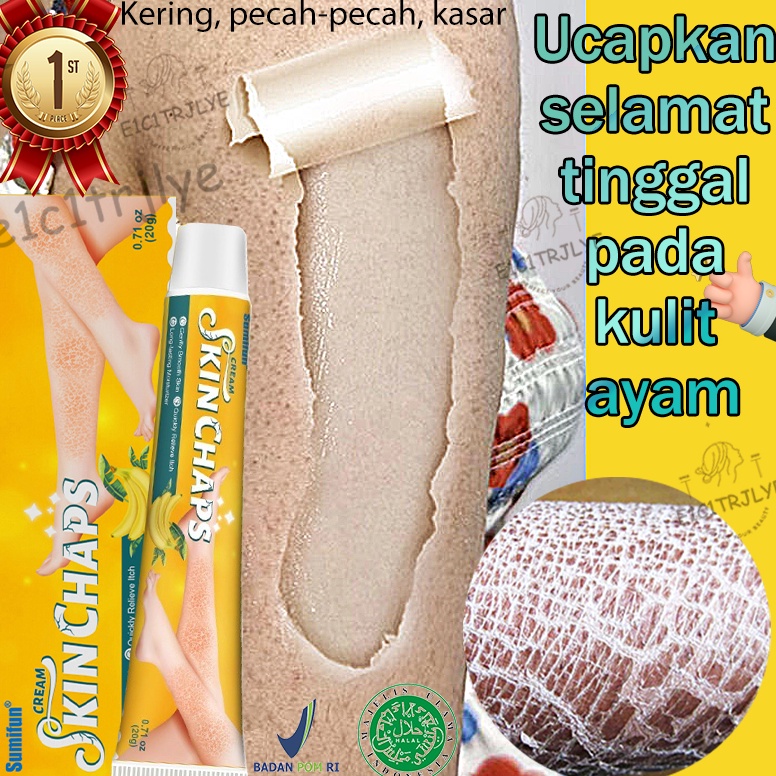 Obat Penghilang Kulit Iktiosis Di Tubuh Bersisik Kering Mudah PecahPecah Kulit Kemerahan Terasa Gata