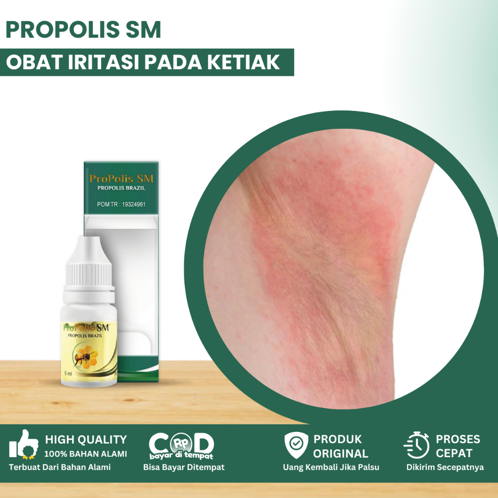 Obat Iritasi Pada Ketiak, Obat Ketiak Gatal, Obat Ketiak Lecet Dan Perih, Gatal Merah Pada Ketiak, K