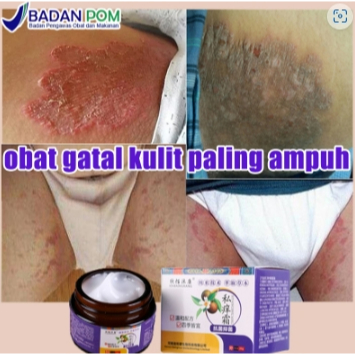 Salep gatal paling ampuh obat gatal selangkangan obat gatal paling ampuh 30g salep cina obat gatal s