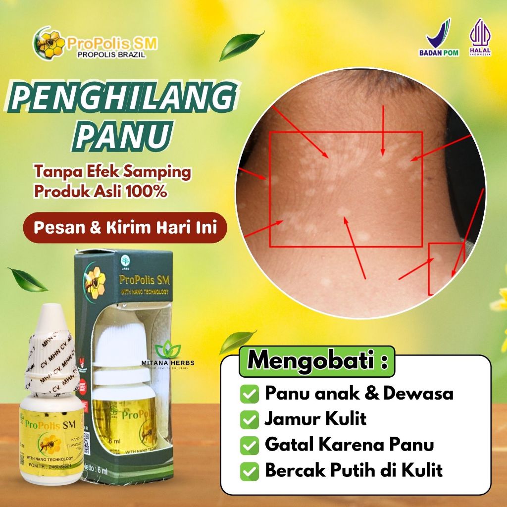 Obat Panu, Penghilang Panu, Obat Panu Anak, Obat Hapur Kulit, Penghilang Panu di Badan di Wajah