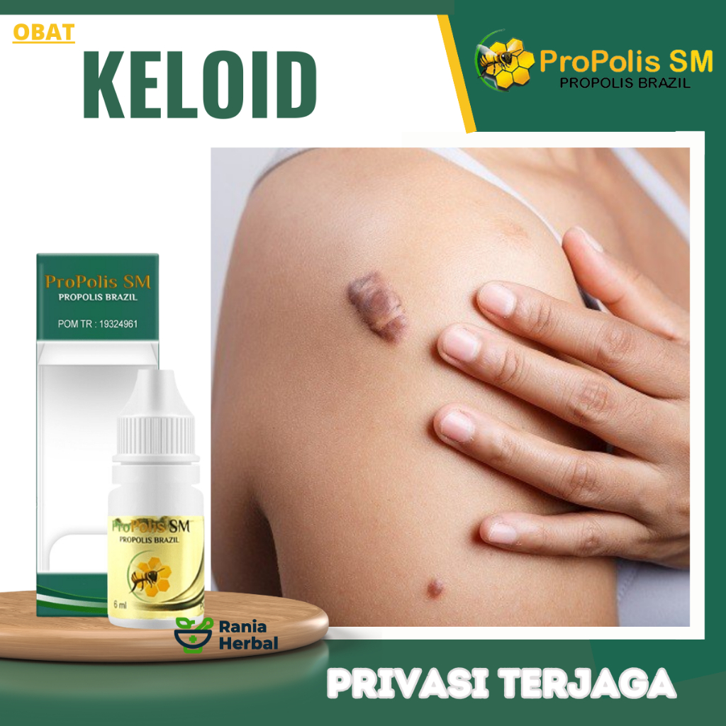 Obat Keloid, Obat Penghilang Keloid Di Dada, Obat Keloid Bekas Operasi, Obat Keloid Injeksi, Obat ke
