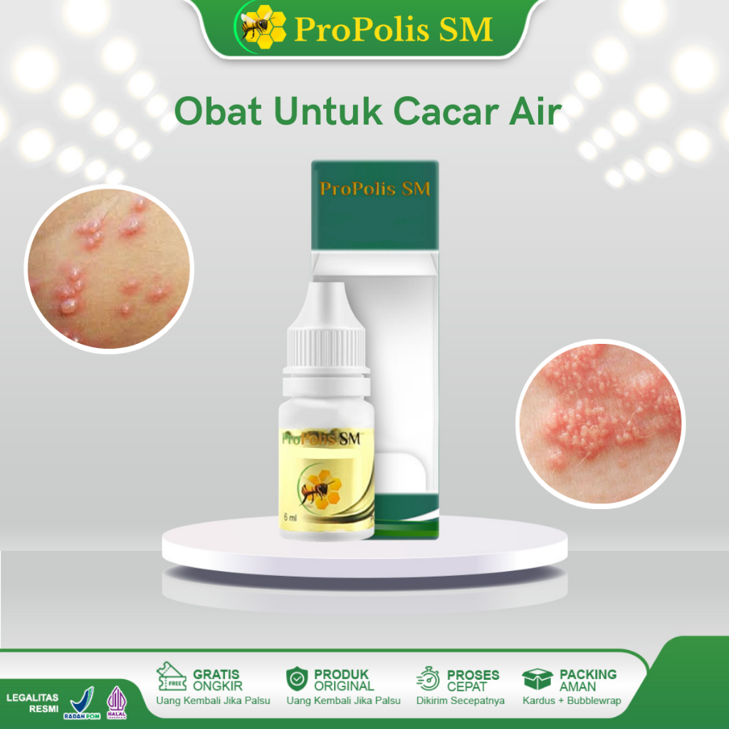 Obat Campak Cacar Air Anak Dewasa Cacar Air Api Gatal Campak Berair Salep Campak Cacar Ayam Cacar Mo