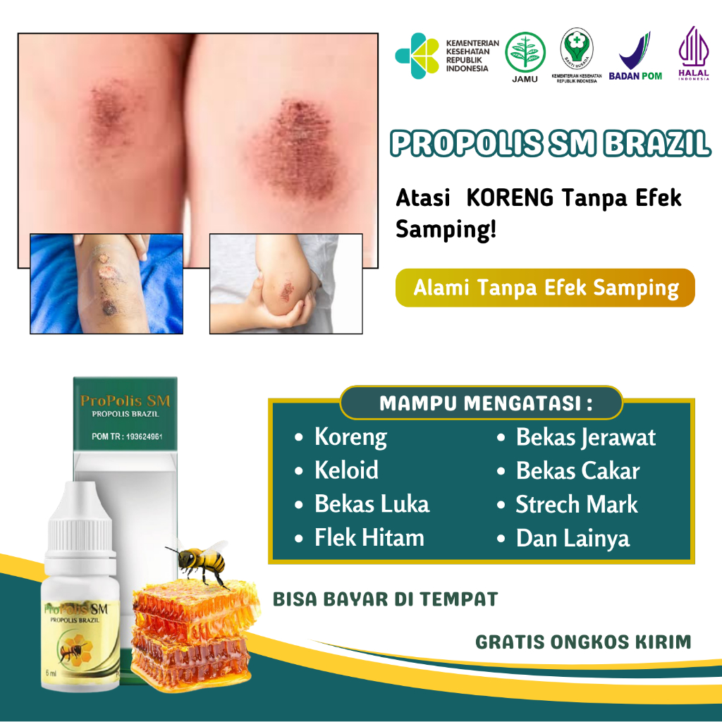 Obat Koreng Borok Cacar Anak Dan Dewasa Propolis SM