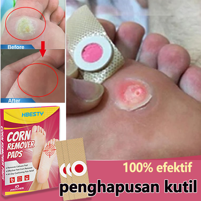 Plester Mata Ikan Plester Obat Kutil Foot Corn Removal Patch Plester Obat Kutil Obat mata ikan Pengh