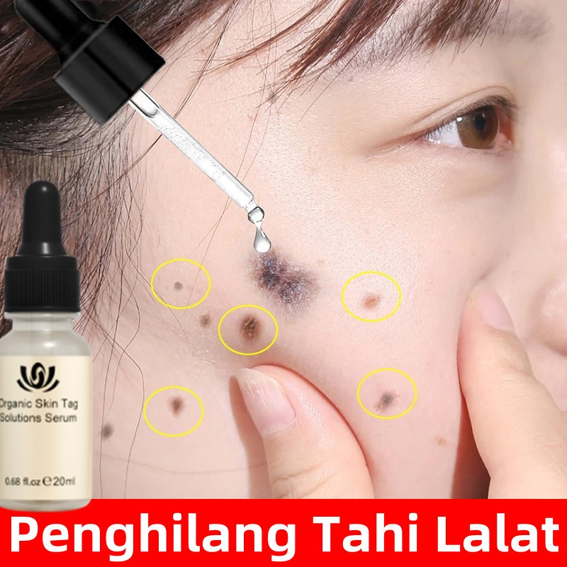 Penghilang Tahi Lalat Penghilang Kutil Skin Tag Remover Flek Dan Bintik Menghilangkan Pigmen Hitam K