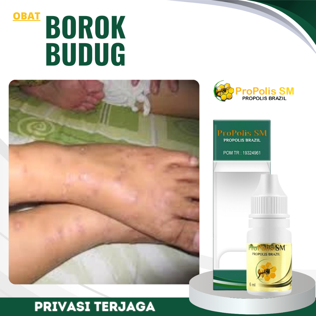 Obat Borok Budug Bernanah, Obat Kaki Borok, Obat Budug Santri, Obat Eksim, Obat Kurap, Obat Kudis, O
