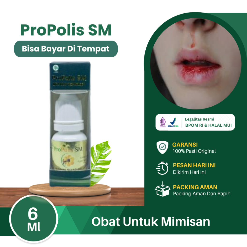 Obat Untuk Mimisan Hidung, Mimisan Disertai Sakit Kepala, Hidung Keluar Darah, Mimisan Menahun, Mimi