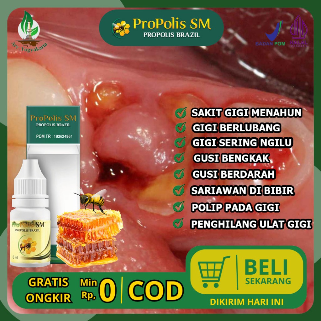 Obat Penghilang Daging Di Lubang Gigi, Daging Jadi, Gusi Tumbuh Di Lubang Gigi, Polip Gigi / Polip G