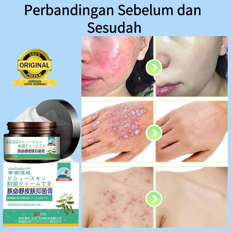 Salep gatal selangkangan salep gatal paling ampuh Obat selangkangan gatal dan hitam krim gatal psori