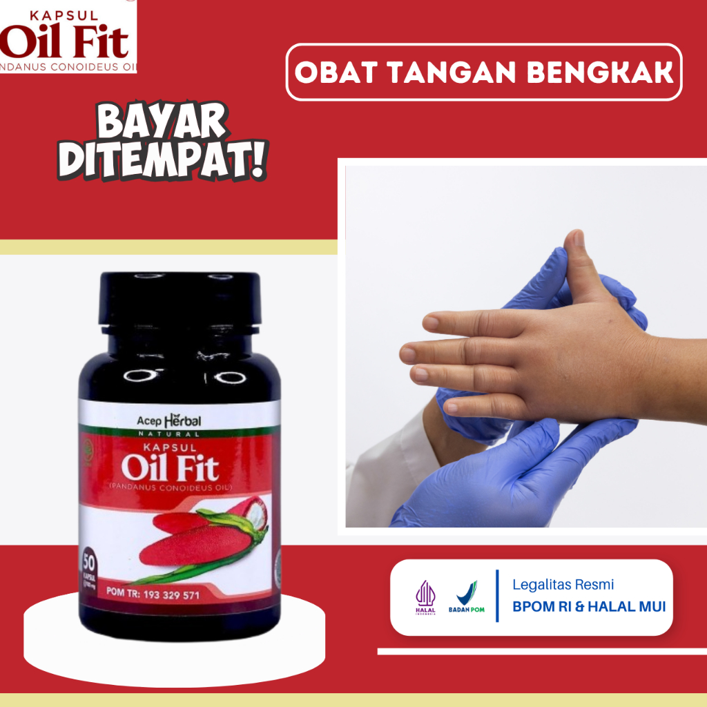Obat Tangan Bengkak, Obat Tangan Bengkak Dan Nyeri, Obat Pergelangan Tangan Bengkak, Obat Jari Tanga