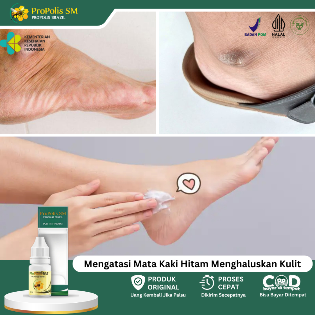 Obat Mata Kaki Hitam, Penghilang Mata Kaki Hitam, Kaki Kapalan, Nyeri Mata Kaki, Mata Ikan Di Telapa