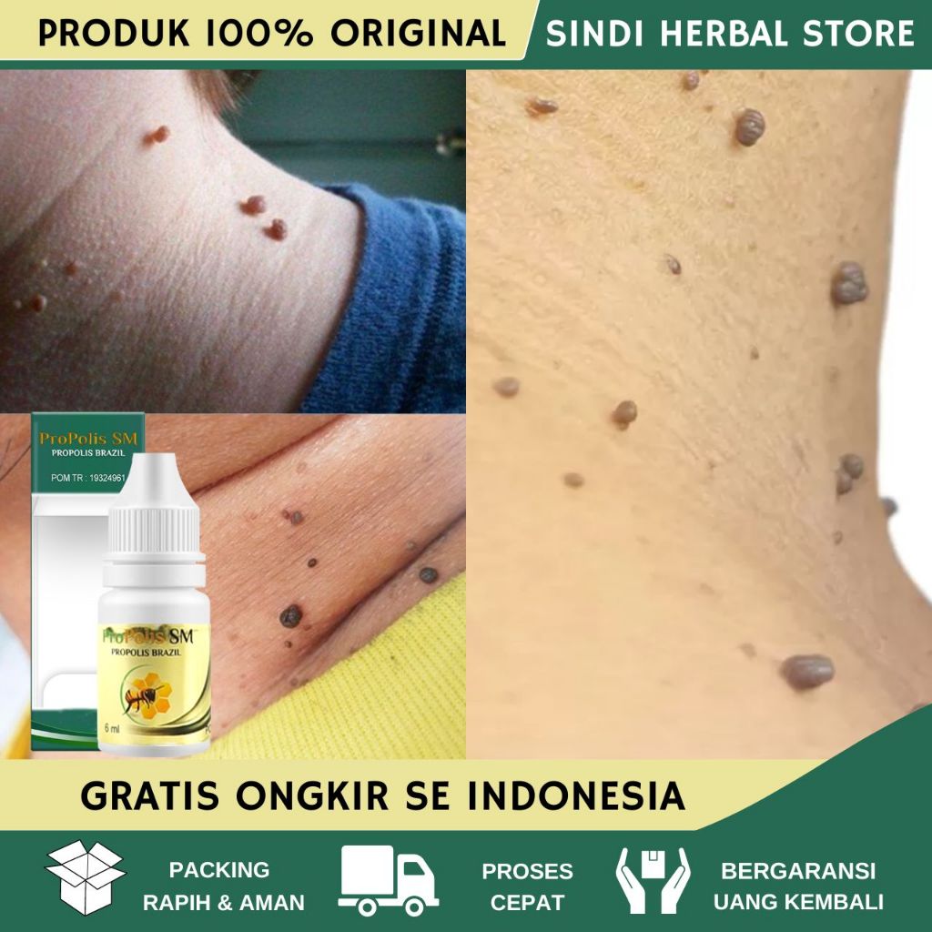 Obat Kutil Papiloma di Leher - Obat Penghilang Kutil - Obat Perontok Kutil Papiloma - Obat Skin Tag 
