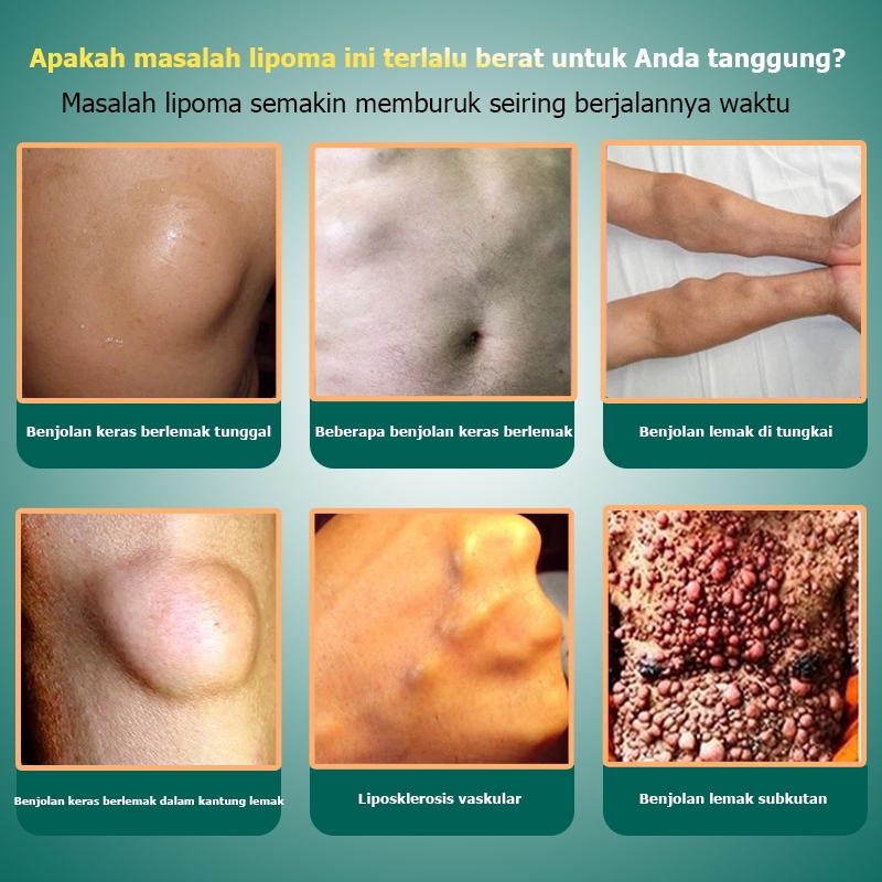 ADY78 Lipoma cream original Obat benjolan Lipoma removal cream original Obat lipoma Salep lipoma