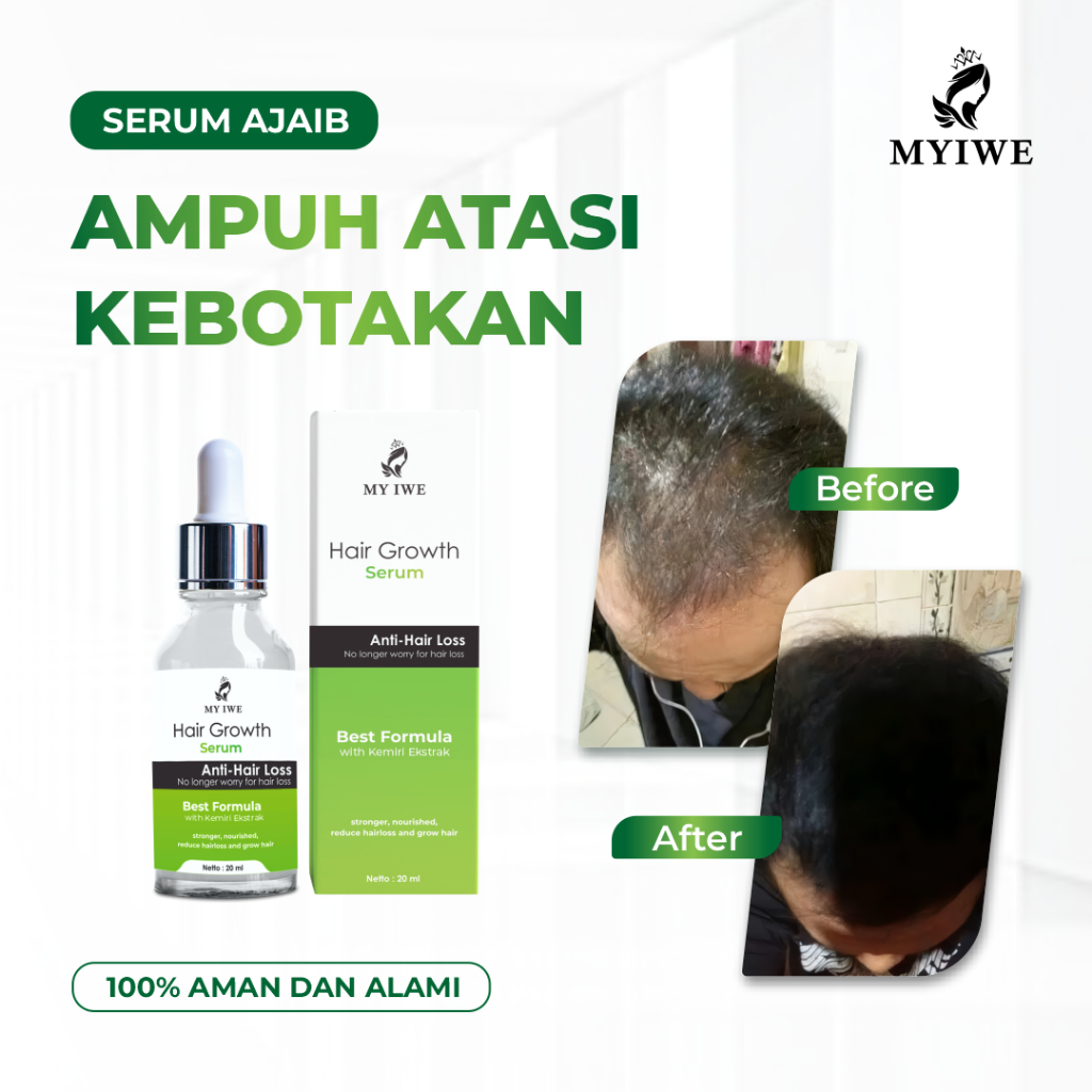 Myiwe Hair Growth Serum Penumbuh Rambut Botak dan Cegah Rontok