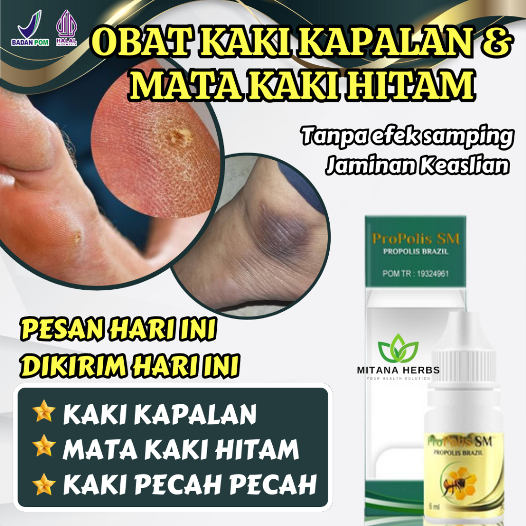 Obat Mata Kaki Hitam - Obat Kaki Kapalan - Obat Kaki Pecah Pecah Dan Kering - Obat Mata Kaki Bengkak