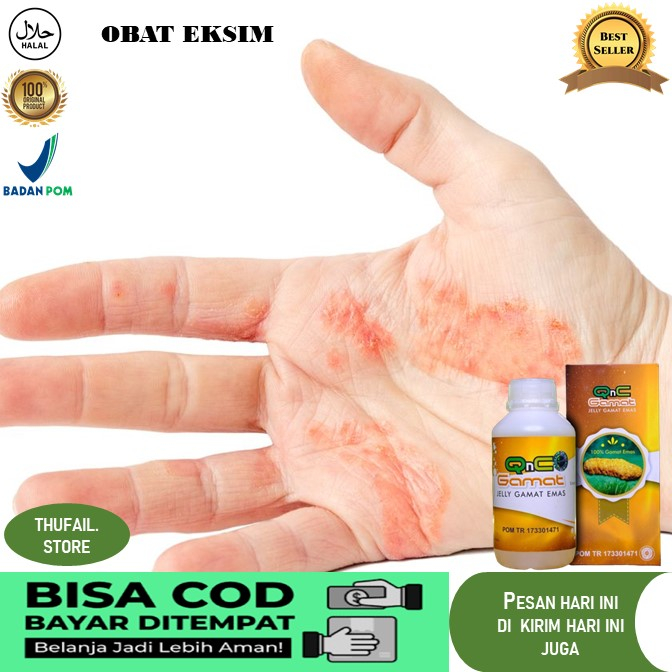 obat eksim Obat Eksim Kering Obat Eksim Kering Menahun, Obat Gatal Eksim, Obat Eksim Gatal, Obat Gat